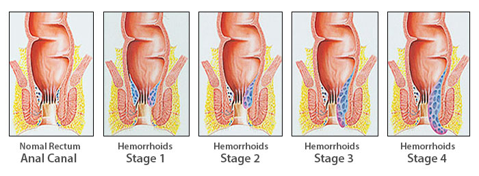 hemorrhoid stages chart
